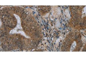 Immunohistochemistry of paraffin-embedded Human colon cancer using NAT10 Polyclonal Antibody at dilution of 1:40 (NAT10 anticorps)