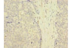 Immunohistochemistry of paraffin-embedded human gastric cancer using ABIN7176509 at dilution of 1:100 (ZNF77 anticorps  (AA 51-369))