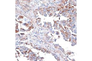 Immunohistochemistry of paraffin-embedded human lung cancer using TIM-3/H antibody (ABIN3016172, ABIN3016173, ABIN3016174, ABIN1680159 and ABIN6219599) at dilution of 1:100 (40x lens).