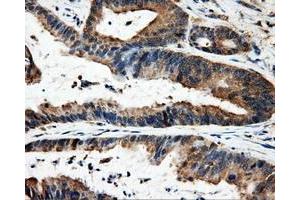 Immunohistochemical staining of paraffin-embedded Adenocarcinoma of colon tissue using anti-FAHD2Amouse monoclonal antibody. (FAHD2A anticorps)