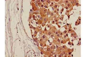Immunohistochemistry of paraffin-embedded human breast cancer using ABIN7146220 at dilution of 1:100 (CDH18 anticorps  (AA 66-251))