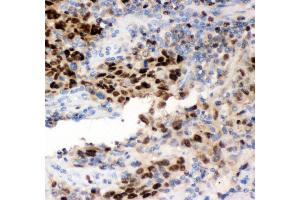 Anti- MCM7 Picoband antibody,IHC(P) IHC(P): Human Lung Cancer Tissue