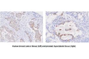 Paraffin embedded sections of human breast cancer and prostate hyperplasia tissue were incubated with anti-human STEAP1 (1:50) for 2 hours at room temperature. (STEAP1 anticorps  (AA 1-70))