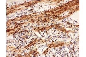 IHC-P: COX1 antibody testing of human intestine cancer tissue