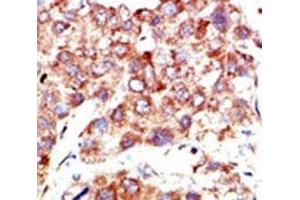 IHC analysis of FFPE human hepatocarcinoma stained with the NEDD8 antibody (NEDD8 anticorps  (AA 1-32))