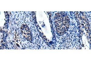 Immunohistochemistry of paraffin-embedded Human cervical cancer tissue using TRIM23 Polyclonal Antibody at dilution of 1:55(x200) (TRIM23 anticorps)