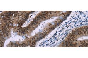 Immunohistochemistry of paraffin-embedded Human colon cancer tissue using HMGA1 Polyclonal Antibody at dilution 1:30