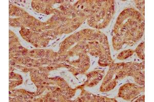 IHC image of ABIN7156114 diluted at 1:600 and staining in paraffin-embedded human liver cancer performed on a Leica BondTM system. (ILDR1 anticorps  (AA 393-541))