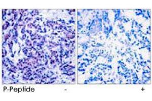 Immunohistochemical analysis of paraffin-embedded human breast carcinoma tissue using JUND (phospho S255) polyclonal antibody .