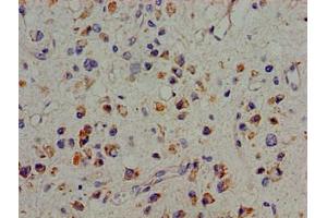 Immunohistochemistry of paraffin-embedded human glioma using ABIN7166444 at dilution of 1:100