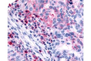 Anti-HRH4 / Histamine H4 Receptor antibody IHC of human Ovary, Carcinoma and Inflammatory Cells. (HRH4 anticorps  (Cytoplasmic Domain))