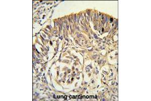 Formalin-fixed and paraffin-embedded human lung carcinoma reacted with PLTP Antibody , which was peroxidase-conjugated to the secondary antibody, followed by DAB staining. (PLTP anticorps  (C-Term))