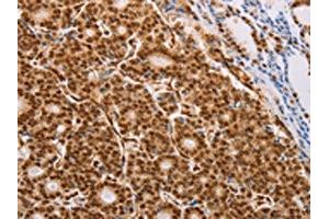 The image on the left is immunohistochemistry of paraffin-embedded Human thyroid cancer tissue using ABIN7130740(PSMD3 Antibody) at dilution 1/25, on the right is treated with fusion protein.