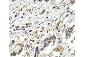 Immunohistochemistry of paraffin-embedded Human breast cancer using BUB1B Polyclonal Antibody at dilution of 1:200 (40x lens).