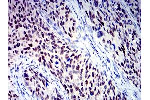 Immunohistochemical analysis of paraffin-embedded cervical cancer tissues using BCL9L mouse mAb with DAB staining.