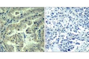 Immunohistochemical analysis of paraffin-embedded human lung carcinoma tissue using eIF4G (phospho-Ser1232) antibody (E011514). (EIF4G1 anticorps  (pSer1232))