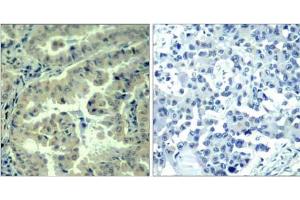 Immunohistochemical analysis of paraffin-embedded human lung carcinoma tissue using eIF4G (phospho-Ser1232) antibody (E011514). (EIF4G1 anticorps  (pSer1232))
