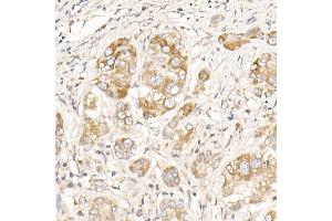Immunohistochemistry of paraffin-embedded human liver cancer using PG Rabbit pAb (ABIN7269317) at dilution of 1:25 (40x lens).