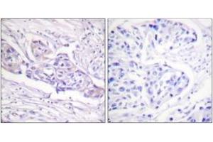 Immunohistochemistry analysis of paraffin-embedded human breast carcinoma, using FOXO1A (Phospho-Ser329) Antibody. (FOXO1 anticorps  (pSer329))