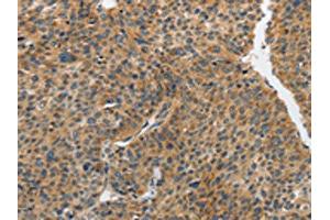 The image on the left is immunohistochemistry of paraffin-embedded Human liver cancer tissue using ABIN7191891(PIP5K1C Antibody) at dilution 1/25, on the right is treated with synthetic peptide. (PIP5K1C anticorps)
