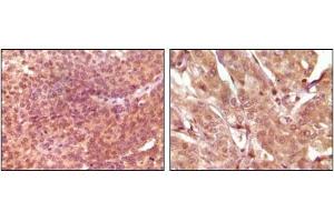 Immunohistochemical analysis of paraffin-embedded human bladder carcinoma (left) and breast carcinoma (right), showing nuclear and cytoplasmic localization using SRA antibody with DAB staining.