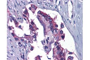Anti-GFPT1 / GFAT antibody IHC of human Pancreas, Carcinoma. (GFPT1 anticorps  (C-Term))