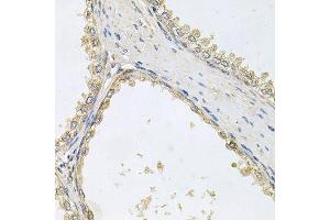 Immunohistochemistry of paraffin-embedded human prostate using POMGNT1 antibody. (POMGNT1 anticorps  (AA 411-660))