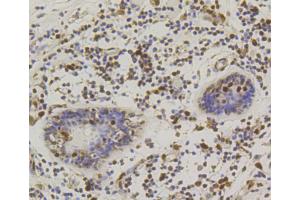 Immunohistochemistry of paraffin-embedded human mammary cancer using CREB1 antibody (ABIN5996963) at dilution of 1/100 (40x lens). (CREB1 anticorps)