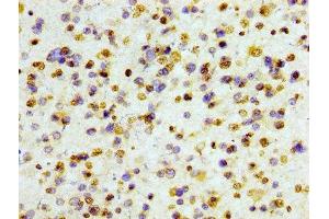 IHC image of ABIN7127295 diluted at 1:100 and staining in paraffin-embedded human glioma cancer performed on a Leica BondTM system.