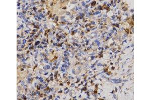 Immunohistochemistry of paraffin-embedded Human lung cancer using Eif2ak2 Polyclonal Antibody at dilution of 1:200 (40x lens). (EIF2AK2 anticorps)