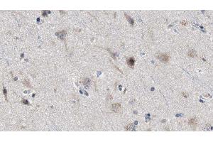 ABIN6277974 at 1/100 staining Human brain cancer tissue by IHC-P. (Presenilin 2 anticorps  (Internal Region))