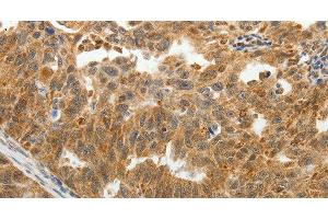 Immunohistochemistry of paraffin-embedded Human ovarian cancer tissue using SOCS7 Polyclonal Antibody at dilution 1:30 (SOCS7 anticorps)