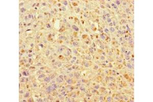 Immunohistochemistry of paraffin-embedded human melanoma using ABIN7157632 at dilution of 1:100 (KIF24 anticorps  (AA 1168-1368))