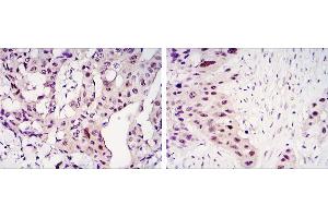 Immunohistochemical analysis of paraffin-embedded mammary cancer tissues (left) and lung cancer tissues (right) using STAT3 mouse mAb with DAB staining. (STAT3 anticorps)