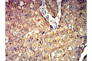 Immunohistochemical analysis of paraffin-embedded bladder cancer tissues using ALDOA mouse mAb with DAB staining. (ALDOA anticorps  (AA 9-145))