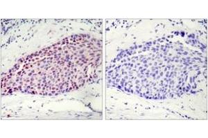 Immunohistochemistry analysis of paraffin-embedded human breast carcinoma tissue, using ATF2 (Ab-112 or 94) Antibody. (ATF2 anticorps  (AA 79-128))
