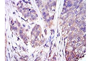 Immunohistochemical analysis of paraffin-embedded bladder cancer tissues using MAPK3 mouse mAb with DAB staining. (ERK1 anticorps)