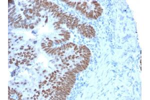Formalin-fixed, paraffin-embedded human Colon Carcinoma stained with CDX2 Mouse Monoclonal Antibody (CDX2/2214). (CDX2 anticorps)