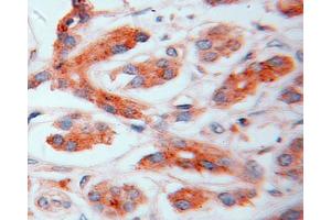IHC analysis of paraffin-embedded human pancreas cancer tissue, using GAA antibody (1/50 dilution, 40X lens).