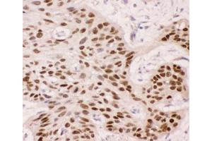 IHC-P: p63 antibody testing of human oesophagus squama cancer tissue