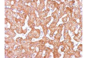 IHC-P Image Immunohistochemical analysis of paraffin-embedded human hepatoma, using GCP2, antibody at 1:500 dilution. (TUBGCP2 anticorps  (N-Term))
