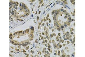 Immunohistochemistry of paraffin-embedded Human breast cancer using EBAG9 Polyclonal Antibody at dilution of 1:100 (40x lens). (RCAS1 anticorps)