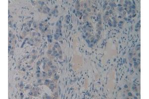 Detection of PACAP in Human Breast cancer Tissue using Polyclonal Antibody to Pituitary Adenylate Cyclase Activating Peptide (PACAP)