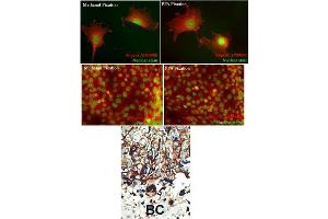 Formalin-fixed and paraffin-embedded human cancer tissue reacted with the primary antibody, which was peroxidase-conjugated to the secondary antibody, followed by DAB staining.