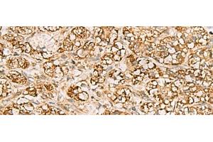 Immunohistochemistry of paraffin-embedded Human liver cancer tissue using MTAP Polyclonal Antibody at dilution of 1:70(x200) (MTAP anticorps)