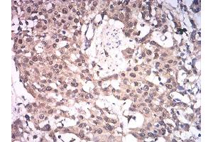 Immunohistochemical analysis of paraffin-embedded esophageal cancer tissues using ASH2L mouse mAb with DAB staining. (ASH2L anticorps  (AA 493-628))