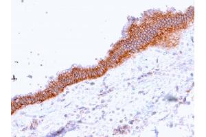 Formalin-fixed, paraffin-embedded human Pancreatic Carcinoma stained with MRP3 Mouse Monoclonal Antibody (ABCC3/2971).
