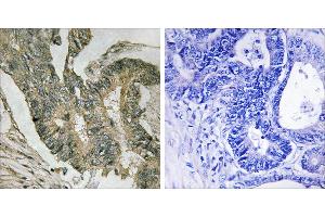 Peptide - +Immunohistochemistry analysis of paraffin-embedded human colon carcinoma tissue using ALDOC antibody. (ALDOC anticorps  (Internal Region))