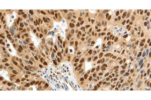 Immunohistochemistry of paraffin-embedded Human ovarian cancer tissue using SSB Polyclonal Antibody at dilution 1:50 (SSB anticorps)