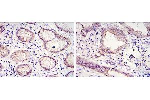 Immunohistochemical analysis of paraffin-embedded gastric cancer tissues (left) and lung cancer tissues (right) using CDH1 mouse mAb with DAB staining.
